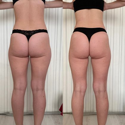 My Vital Glow™ Anti-Cellulite Massager
