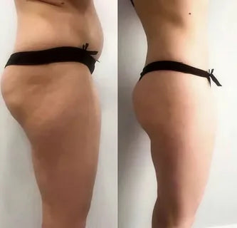 My Vital Glow™ Anti-Cellulite Massager