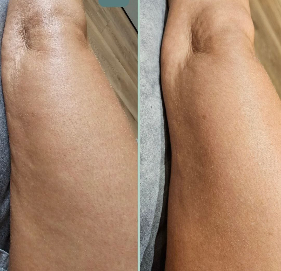 My Vital Glow™ Anti-Cellulite Massager
