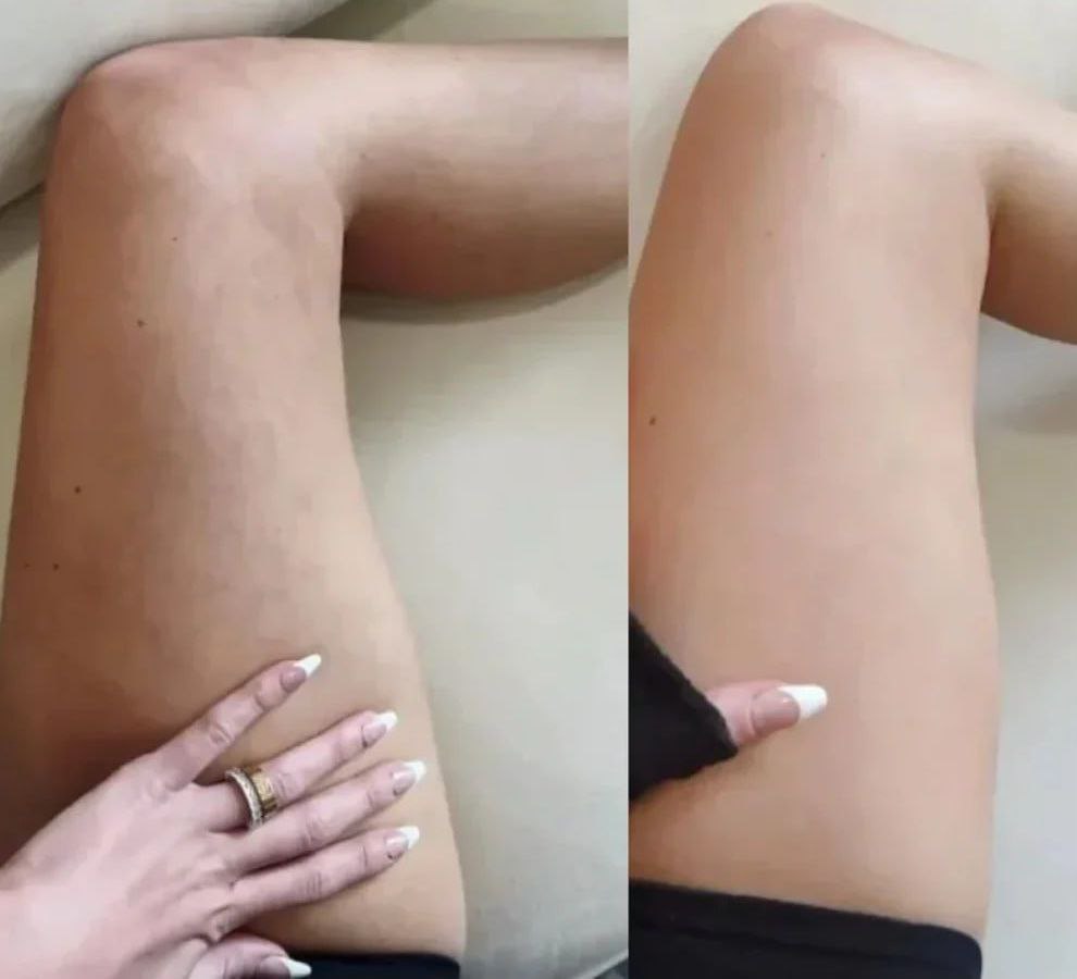 My Vital Glow™ Anti-Cellulite Massager